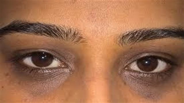 ৩ সবজিতে দূর হবে চোখের নিচে কালো দাগ!